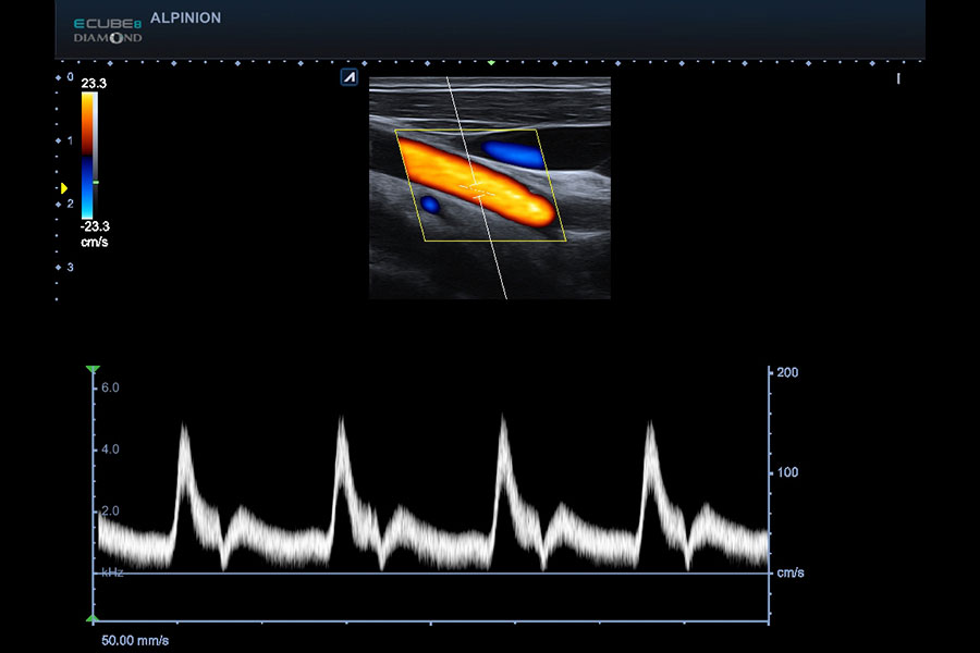 alpinion_carotid_in_PW_mode