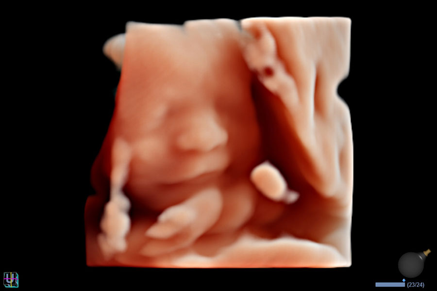 alpinion_fetal_face_in_live_HQ
