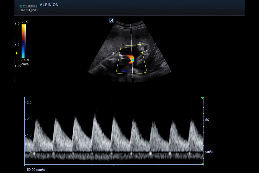 alpinion_umbilical_cord_in_PW