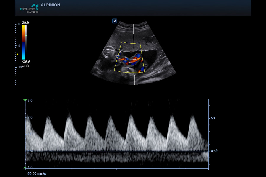 alpinion_umbilical_cord_in_PW_mode