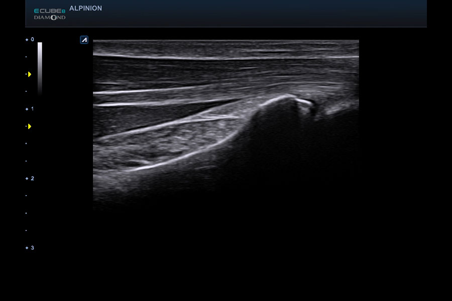 alpinion_wrist_in_2D_mode